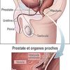 Prévenir le cancer de la prostate