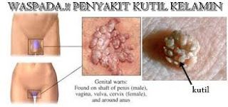 Obat Kutil kelamin disertai keputihan kekuningan