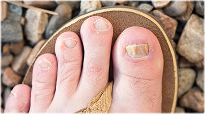 4 Facts About Why People Hide Toenail Fungus