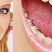 Appareil Dentaire Lingual : présentation générale | Orthodontie Adulte