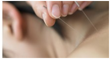 Acupuncture