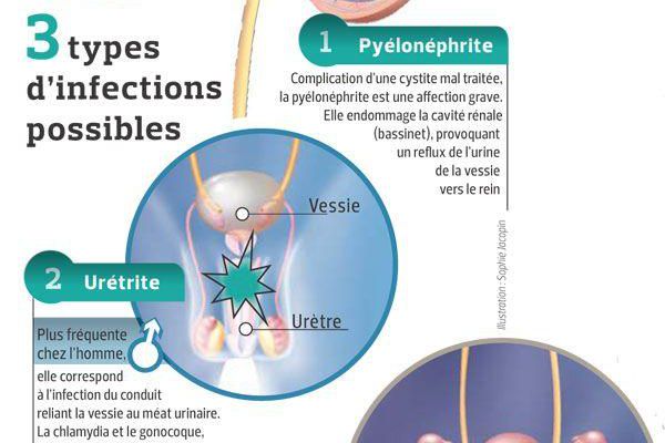 Comment on attrape des infections urinaires