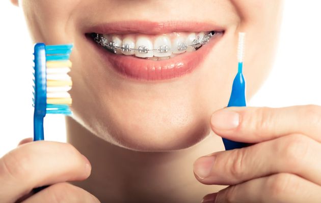 Keep Your Braces Clean At Home With These 4 Steps