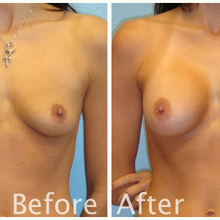Why women choose breast augmentation
