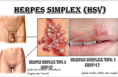 obat penyakit herpes simpleks
