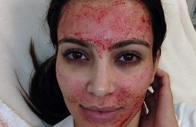 Deux clients d’un #spa contractent le #VIH après un #soin du #visage « #vampire »