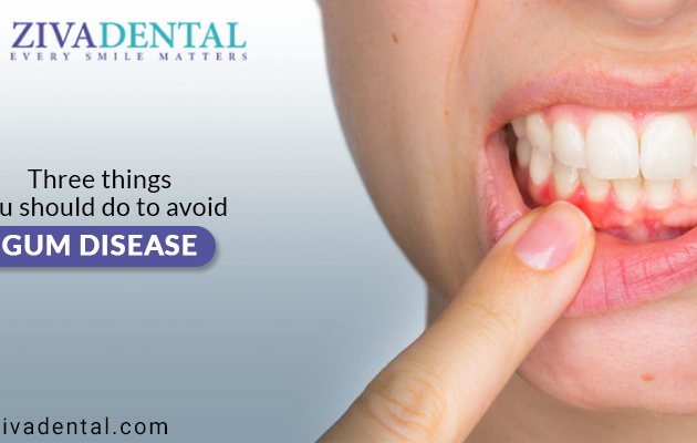 Three things you should do to avoid Gum Disease