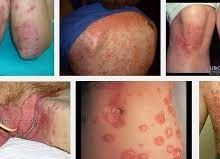 obat manjur menyembuhkan berbagai penyakit gatal kulit