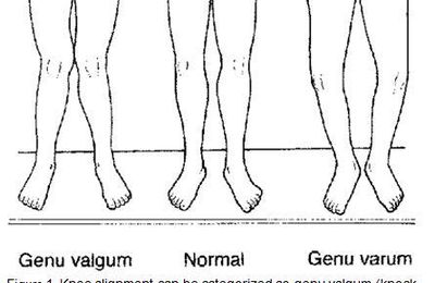 What Genu Varum and Valgum is, and How to Correct It