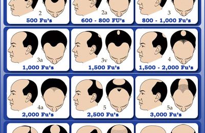 How Many Grafts Do You Need for Hair Transplant?