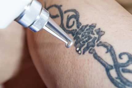 How Modern Laser Tattoo Removal Is Yielding Exceptional Results