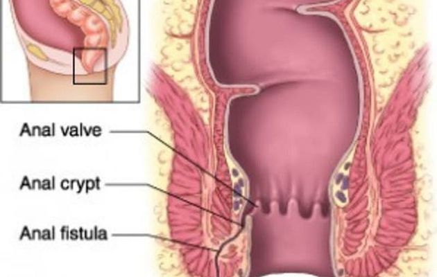 Ciri Ciri Yang Muncul Pada Penderita Penyakit Fistula Ani