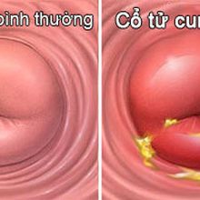 Giải pháp phát hiện bệnh nhiễm trùng cổ tử cung cho phái đẹp