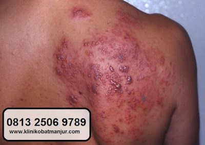 cara mengobati herpes di badan