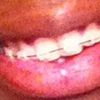 👄Appareil dentaire 4e mois 👄