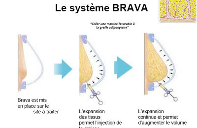 Augmentation mammaire brava