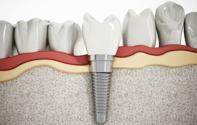 Choosing In Between Oral Implants as well as Bridges