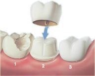 Couronne dentaire douloureuse