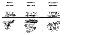 Anaplasia ditandai dengan perubahan intra sel yaitu sintesa macromolecular dan hubungan intrasel serta kesatuan