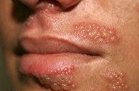 Cara mengobati herpes bibir secara alami