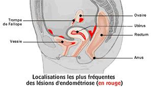 Diagnostiquer l'endométriose pelvienne profonde