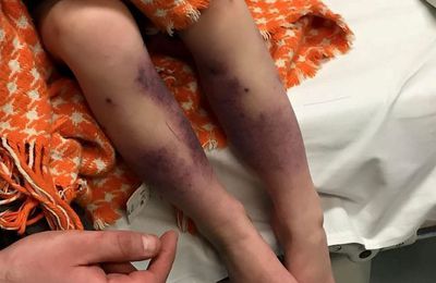 Sa fille se réveille, les jambes couvertes d’ecchymoses. La raison va vous choquer.