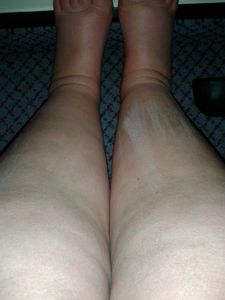 Swollen legs from NKF