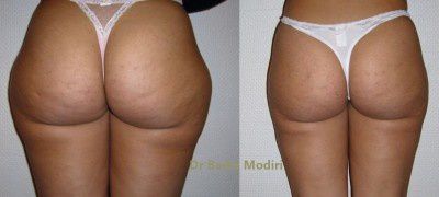 LIPOSUCCION ou LIPOASPIRATION ou LIPOSCULPTURE