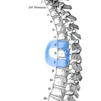 Témoignage fracture Vertèbre T7