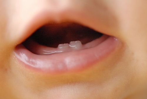 Poussee Dentaire Souvent Douloureuse Mais Pas De Panique Papa Online