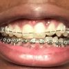 🙅🏽 Appareil dentaire 7e mois + 3e mois bas 💪🏽