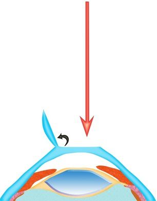 Le LASIK au cœur de la chirurgie réfractive