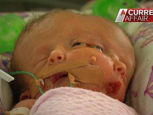 Une australienne donne naissance à un bébé à deux visages