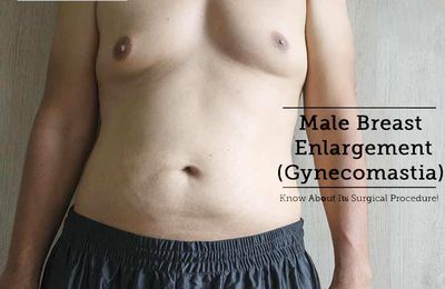 Gynecomastia Surgery for Male Breast Reduction