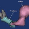Nghiên cứu ứng dụng in 3D để sản xuất các bộ phận giả ở tai giữa