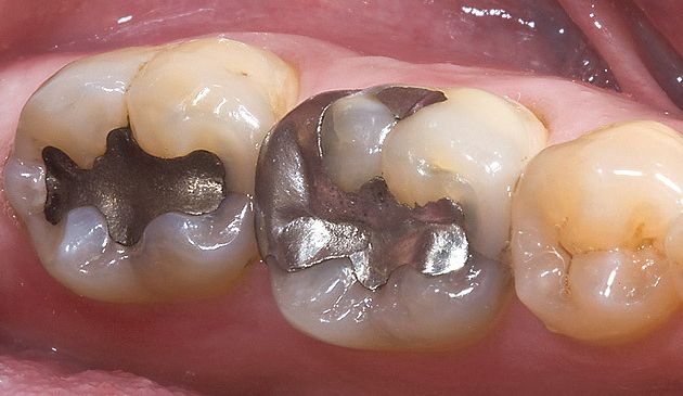 When Should Dental Amalgams Be Removed?