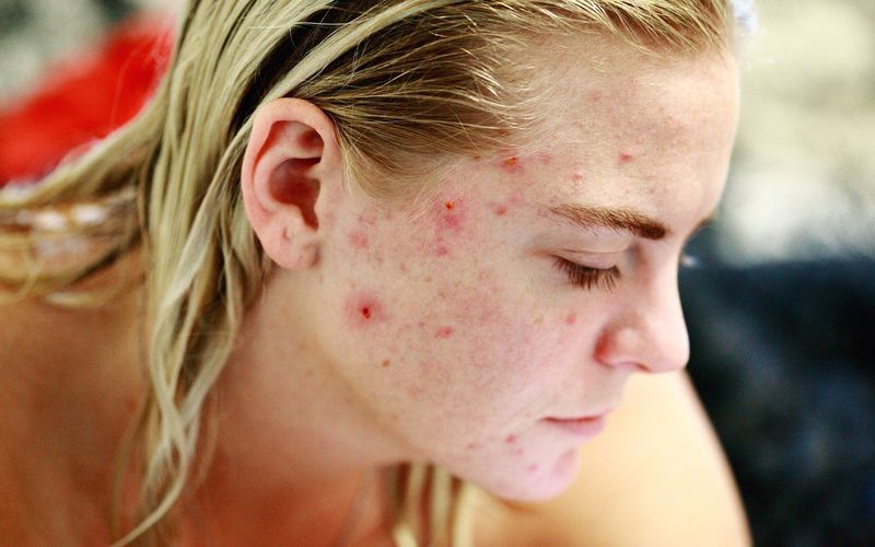 L'acné, comment s'en débarrasser ?