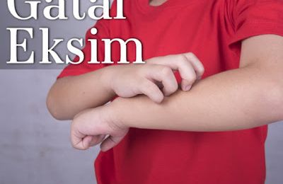 Cara Yang Efektif Mengobati Gatal Eksim Menahun