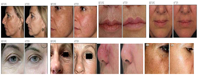 The Note Of CO2 Fractional Laser Treatment