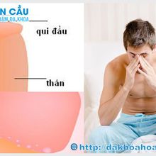 Dây hãm bao quy đầu bị ngắn thì phải điều trị ở đâu là uy tín nhất