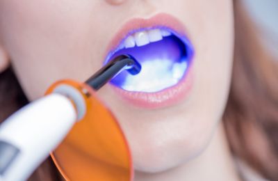 Root Canal Dentist- Best Way To Handle Damaged Pulp For Teeth