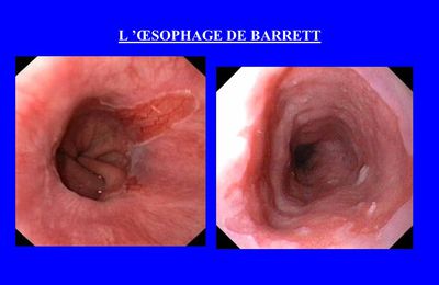 L'osophage de barette regime