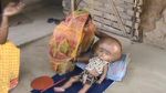 Roona Begum - Âgée de 18 mois et atteinte d'hydrocéphalie