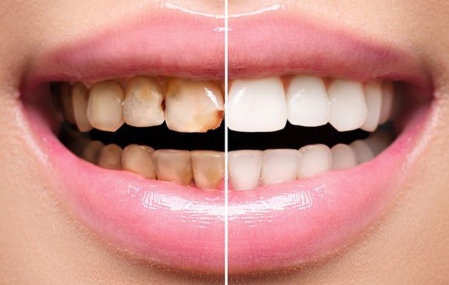Dental Veneers: How Can They Offer You Beautiful Smile?