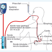 ASPIRATION DIGESTIVE - SONDE NASO-GASTRIQUE à finir - Formation Aide Soignante 2021-2022