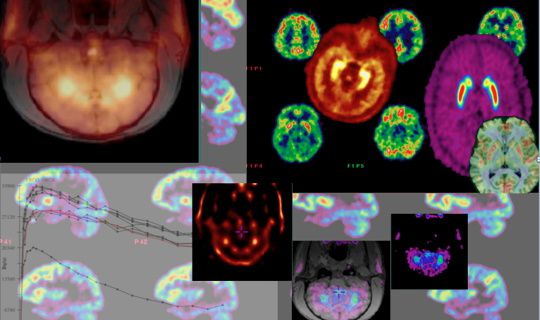 La pauvreté nuit dangereusement au cerveau dès la naissance