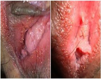 Setelah operasi tumbuh daging kutil di vagina belum ada perubahan? coba salep anpiloma