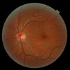 Desprendimiento de retina: causas y tratamiento