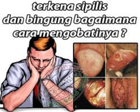 Obat Gonore Siplis Kencing Nanah Di Sibolga