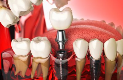 Overview of Dental Implants Dentistry